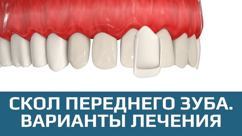 Видео восстановлении зубов винирами