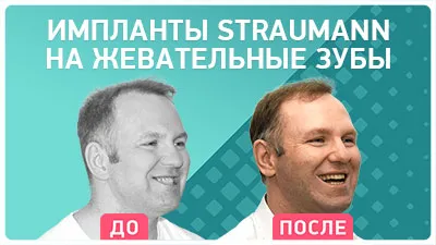 Видео - Имплантация жевательных зубов: отзыв через 1 год