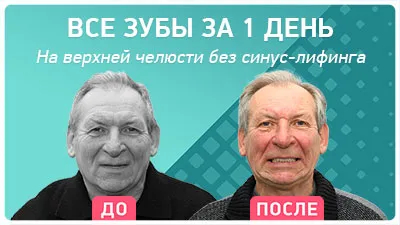 Видео - Имплантация верхней челюсти – зубы за 1 день через 8 месяцев