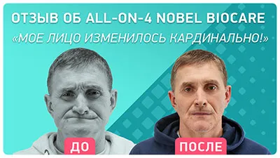 Видео - Кардинальное преображение после all-on-4: как меняются улыбка и прикус