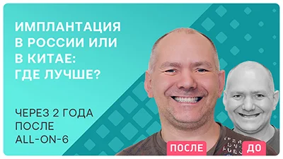 Видео - Имплантация all-on-6 два года спустя