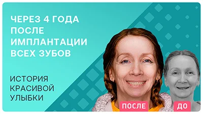 Видео - Комплексная имплантация всех зубов. Отзыв через 4 года после операции