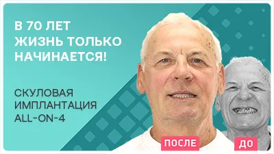 Видео - Имплантация all-on-4 после 70: рассказ реального пациента