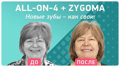 Видео - Имплантация верхней челюсти all-on-4 на NobelZygoma – новые зубы, как свои!