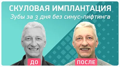 Видео - Скуловая имплантация без наращивания костной ткани: за 3 дня и навсегда