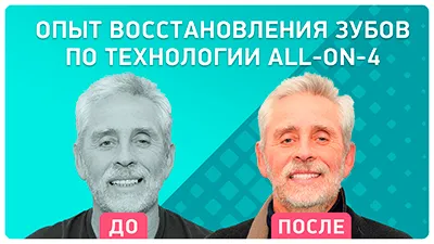 Видео - Перепротезирование через 1 год: опыт восстановления зубов All-on-4