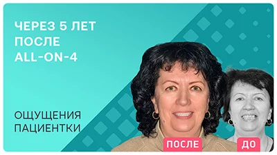 Видео - All-on-4 с отсроченной нагрузкой: ощущения пациентки через 5 лет
