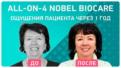 Видео - All-on-4 с отсроченной нагрузкой: ощущения пациентки через 1 год