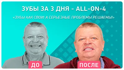 Видео - All-on-4 имплантация: переживания и опыт реального пациента