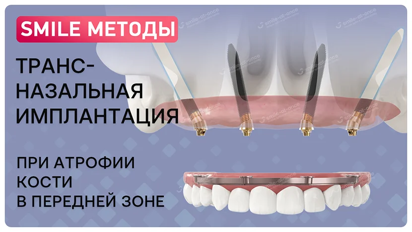 Видео Что такое трансназальная имплантация зубов