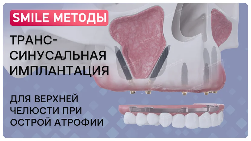 Что такое транссинусальная имплантация зубов