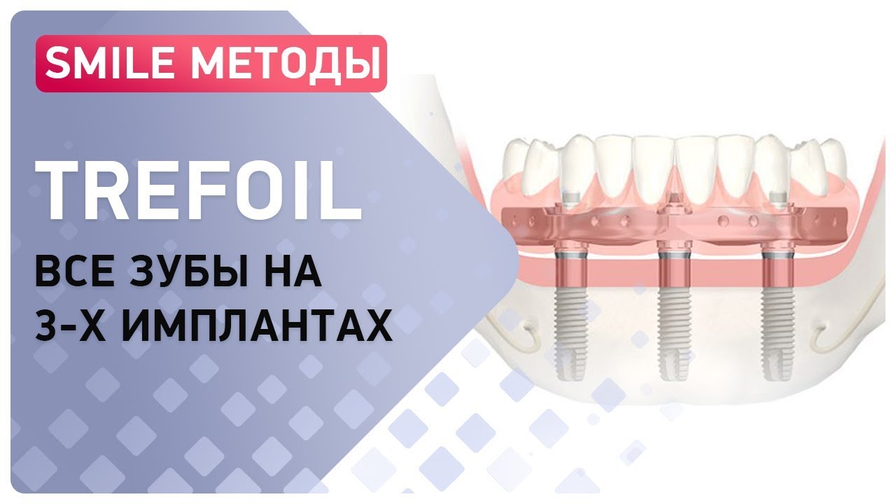 Видео об имплантах Trefoil