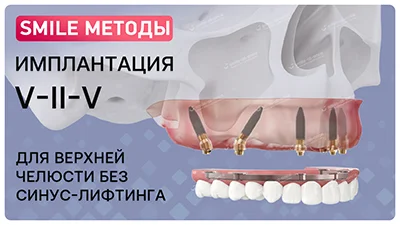 Видео о имплантации зубов методом V-II-V
