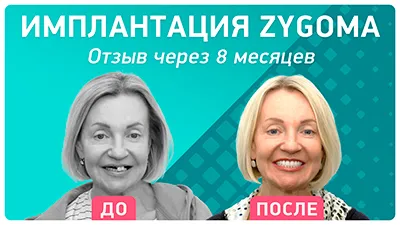 Видео - Имплантация Nobel Zygoma: ощущения через 8 месяцев