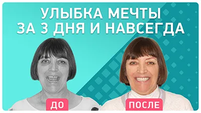 Видео - Имплантация зубов верхней челюсти по протоколу all-on-6. Отзыв пациентки