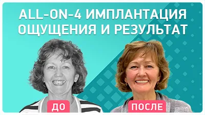 Видео - Имплантация all-on-4: ощущения и результат. Из первых уст – рассказывает пациент