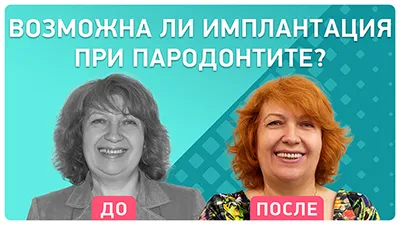 Видео - Комплексная имплантация на фоне пародонтоза. Отзыв пациента об имплантации зубов