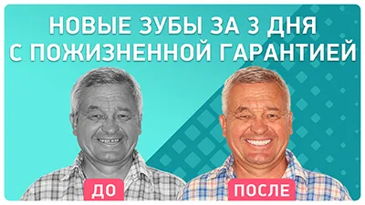 Видео - Отзыв пациента через 2 месяца после комплексной имплантации зубов + фото через 2 года