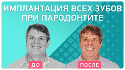 Видео - Красивая и функциональная улыбка за 3 дня. Отзыв пациента о комплексной имплантации зубов