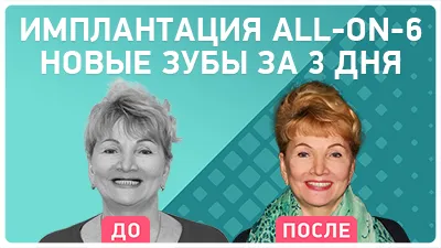 Видео - Отзыв об имплантации all-on-6 – новые зубы за 3 дня