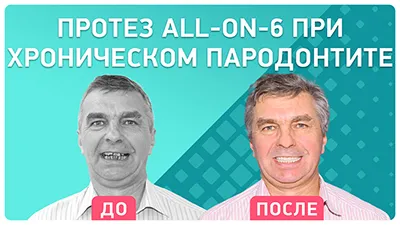 Видео - Протезирование all-on-6: восстановление всех зубов за 3 дня