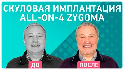 Видео - Отзыв после имплантации all-on-4 с применением скуловых имплантов Zygoma