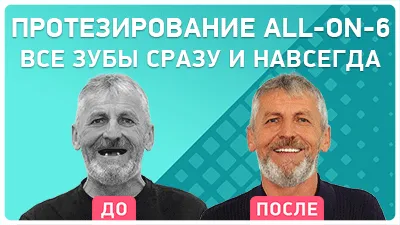 Видео - Отзыв пациента о восстановлении зубов за 3 дня по протоколу комплексной имплантации и all-on-6