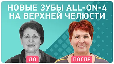 Видео - Протезирование all-on-4 на верхней челюсти: омоложение лица