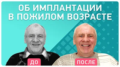 Видео - Условно-съемный зубной протез с опорой на 4-х имплантах. Отзыв пациента