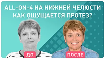 Видео - Об имплантации нижних зубов all-on-4: как быстро привыкаешь к протезам