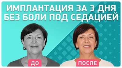 Видео - Подробный отзыв пациента об ощущениях при проведении одноэтапной имплантации зубов