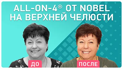 Видео - Как получить улыбку, о которой мечтаешь? Отзыв пациентки об имплантации all-on-4