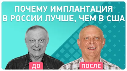 Видео - Протезирование всех зубов. Отзыв пациента из США о комплексной имплантации