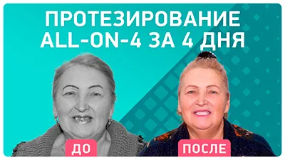 Видео - Видео-отзыв после протезирования all-on-4® на имплантах Nobel