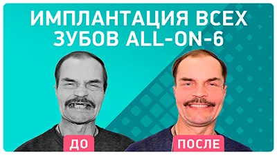 Видео - Этапы лечения и отзыв пациента об имплантации All-on-6