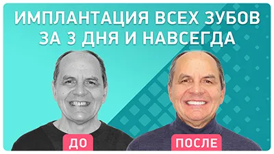 Видео - Полное восстановление зубов при помощи комплексной имплантации: видео-отзыв