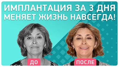 Видео - Имплантация омолаживает и преображает! История пациентки после all-on-4