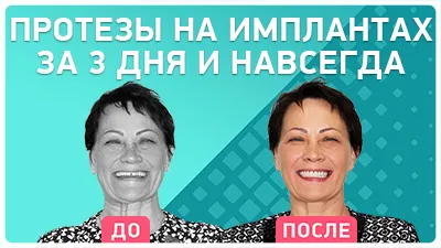 Видео - Как быстро восстановить зубы: видео-отзыв после имплантации с немедленной нагрузкой