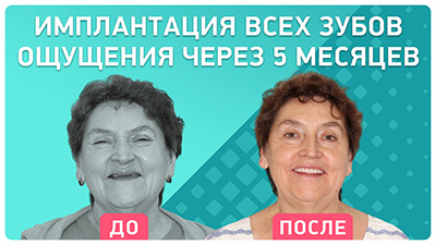 Имплантация зубов у Любви Николаевны