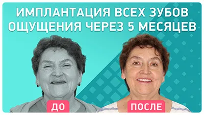 Видео - Через 5 мес. после имплантации вместо съемных протезов при острой атрофии кости