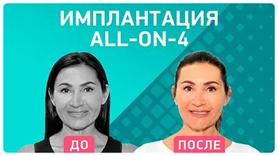 Видео - Имплантация в Москве – это выгодно! Отзыв об All-on-4 пациентки из Волгограда