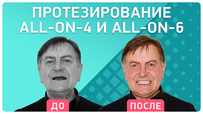 all-on-4 и all-on-6 у Александра Николаевича