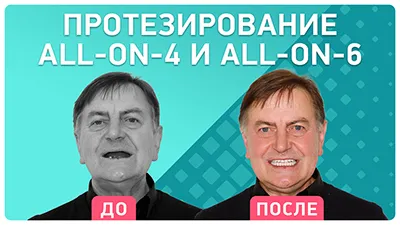 Видео - Протезирование all-on-4 и all-on-6. Видео-отзыв пациента