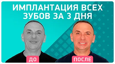 Видео - Полное восстановление зубов на имплантах за 3 дня. Отзыв пациента