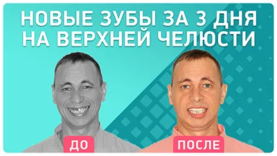 Видео - Восстановление верхних зубов за 3 дня. Как меняется жизнь после имплантации