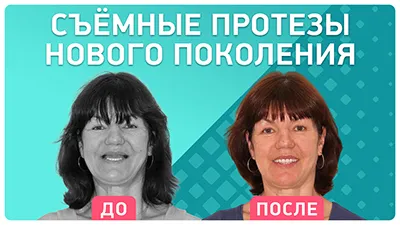 Видео - Зубной протез нового поколения. Отзыв пациентки о протезировании в клинике Smile-at-Once