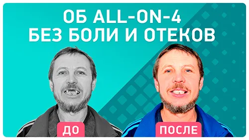 Видео - Имплантация all-on-4: будет ли отек после установки имплантов? Отзыв пациента