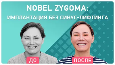 Видео - Скуловая имплантация Nobel Zygoma: опыт реального пациента