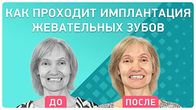 Видео - Имплантация жевательных зубов за 3 дня: видео-отзыв пациента