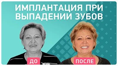 Видео - Имплантация на фоне острого воспаления: быстро и с пожизненной гарантией